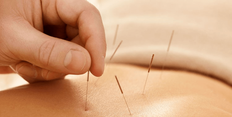 erretzeari aurre egiteko akupuntura